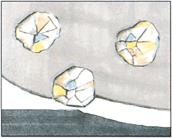 Bild 1: Freilegung des Diamanten bei Bearbeitung des Materials...